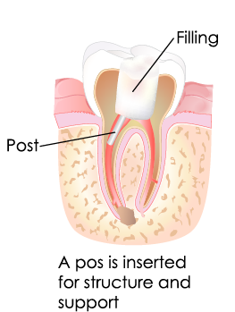 illustration of a root canal showing the filling and post that is inserted for structure and support